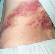 湿疹的症状是怎样的？
